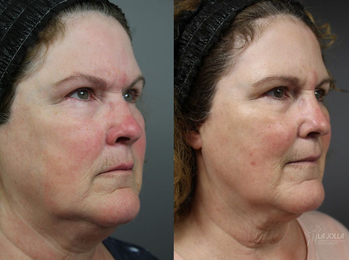 Before and after VBeam case 36121 - Angle 2