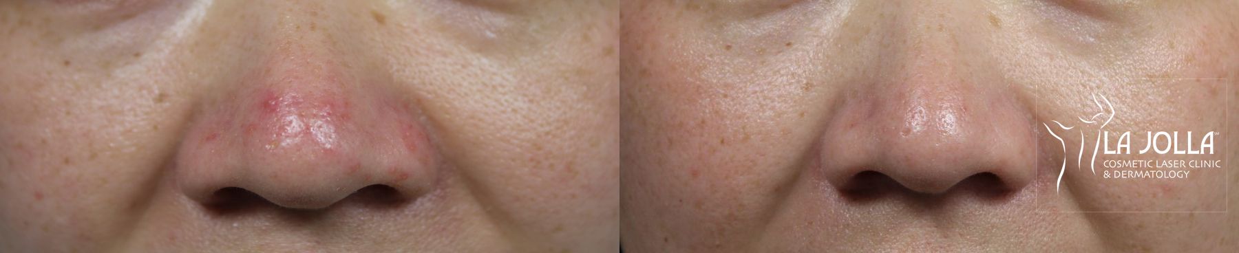 Before and after VBeam case 36189