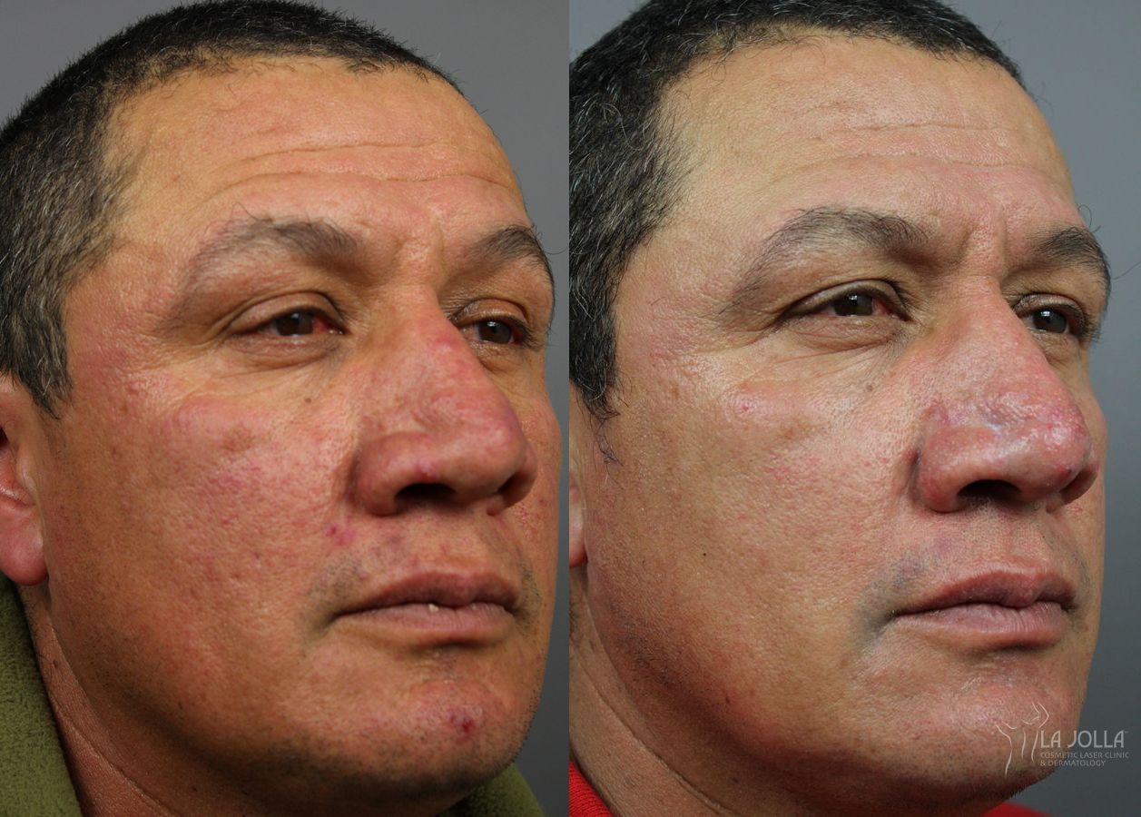 Before and after VBeam case 36118 - Angle 2