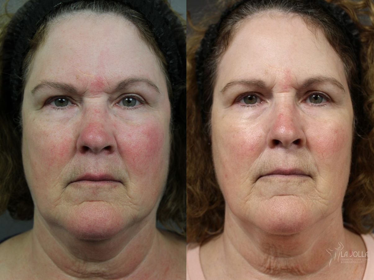 Before and after VBeam case 36121