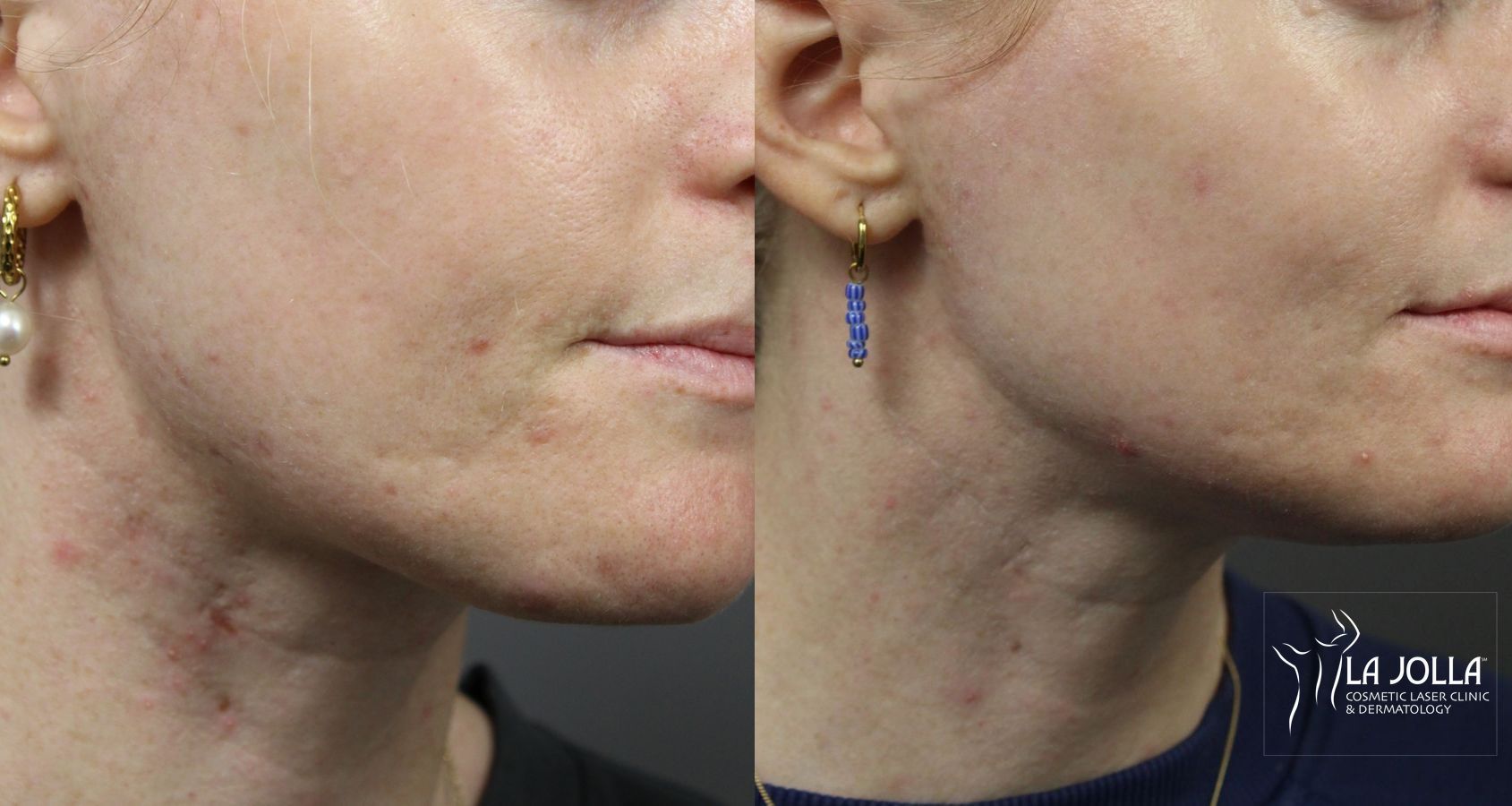 Before and after VBeam case 36085