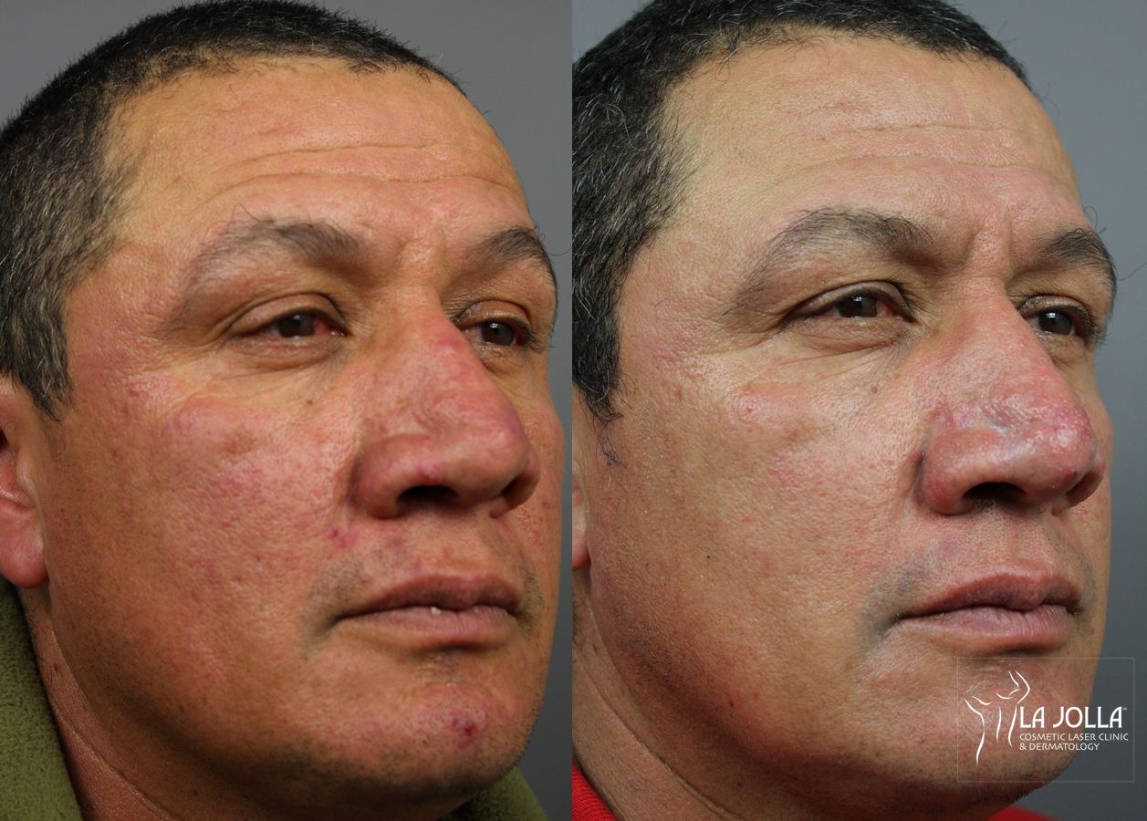 Before and after VBeam case 36118 - Angle 2