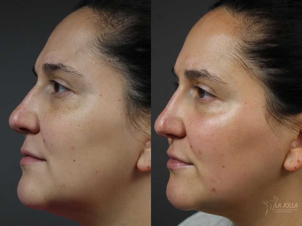 Before and after VBeam case 46316 - Angle 2