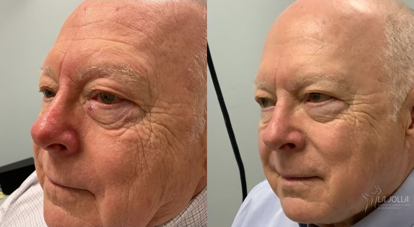 Before and after VBeam case 36169 - Angle 2