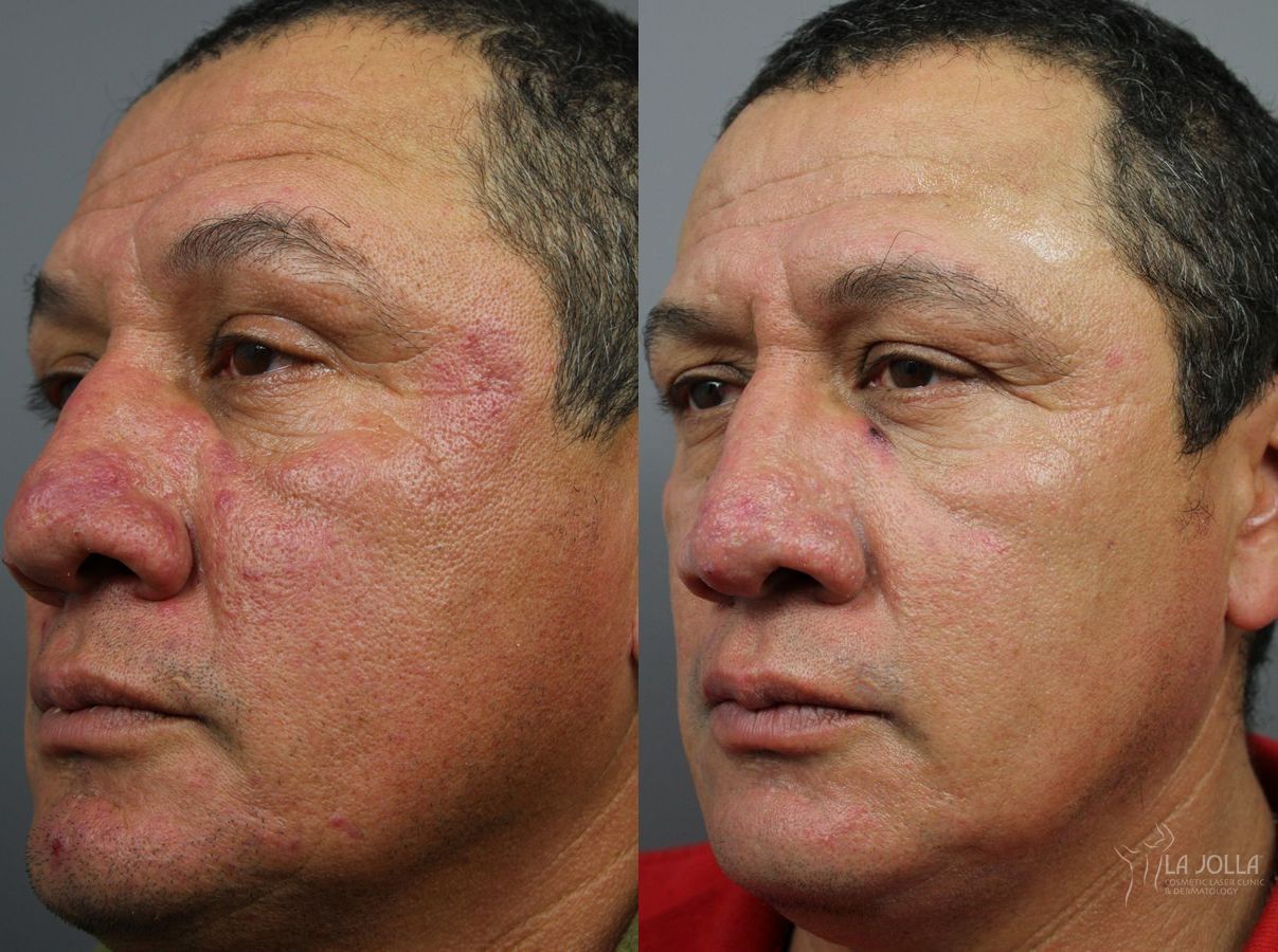Before and after VBeam case 36118