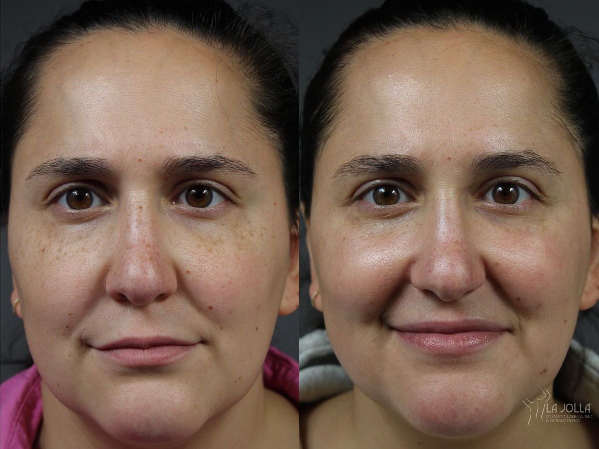 Before and after VBeam case 46316
