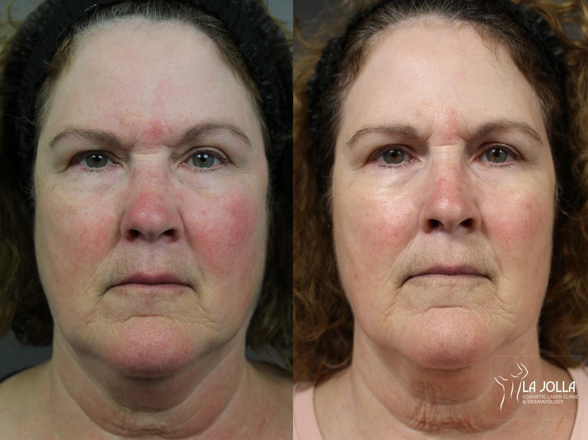 Before and after VBeam case 36121