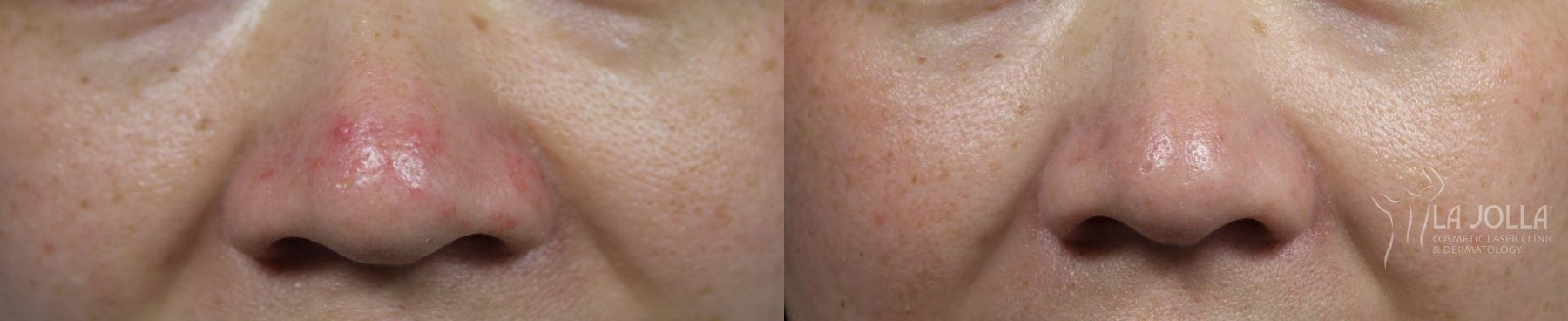 Before and after VBeam case 36189