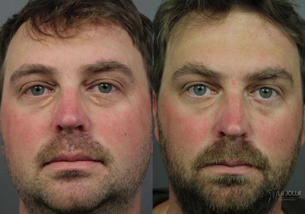 Before and after Xanthelasma case 36127
