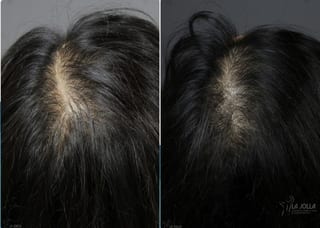 Before and after Laser Hair Growth case 36074 - Angle 1