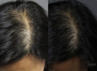 Before and after Laser Hair Growth case 36074 - Angle 2