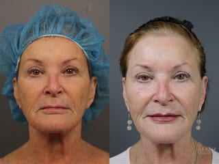 Before and after Fractional CO2 case 36075 - Angle 1