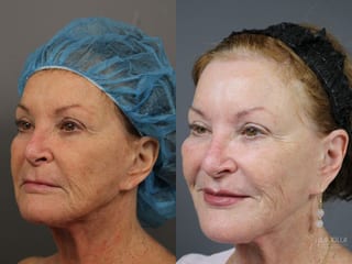 Before and after Fractional CO2 case 36075 - Angle 2