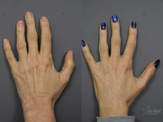 Before and after Hand Rejuvenation case 36076 - Angle 1