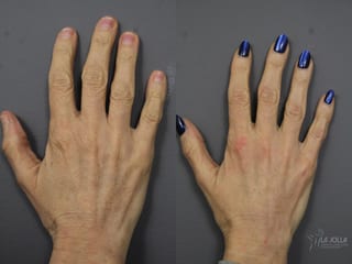 Before and after Hand Rejuvenation case 36076 - Angle 2