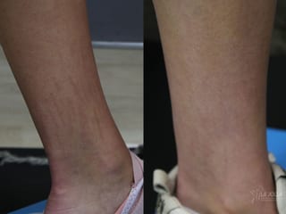 Before and after Fraxel® case 36077 - Angle 1
