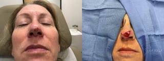 Before and after Mohs Surgery case 36078 - Angle 1