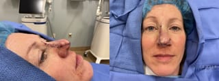 Before and after Mohs Surgery case 36078 - Angle 2
