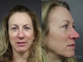 Before and after Mohs Surgery case 36078 - Angle 3