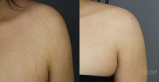 Before and after Stretch Mark case 36079 - Angle 1
