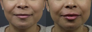 Before and after Lip Filler case 36080 - Angle 1