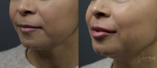 Before and after Lip Filler case 36080 - Angle 2
