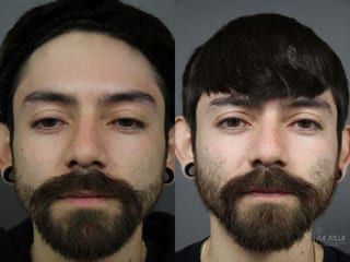Before and after Laser for Rhinophyma case 36081 - Angle 1