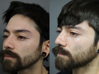 Before and after Laser for Rhinophyma case 36081 - Angle 2