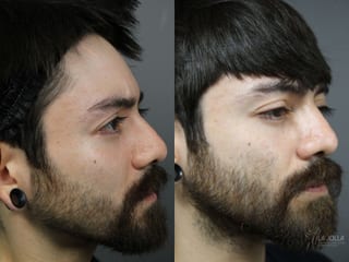 Before and after Laser for Rhinophyma case 36081 - Angle 3