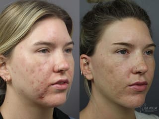 Before and after Acne: Laser Treatment case 36082 - Angle 1