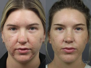 Before and after Acne: Laser Treatment case 36082 - Angle 2