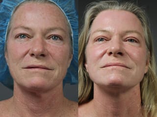 Before and after Ablative Laser Treatment case 36083 - Angle 1