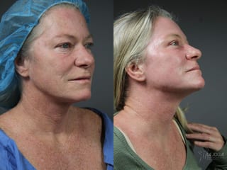 Before and after Ablative Laser Treatment case 36083 - Angle 2