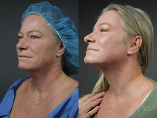Before and after Ablative Laser Treatment case 36083 - Angle 3