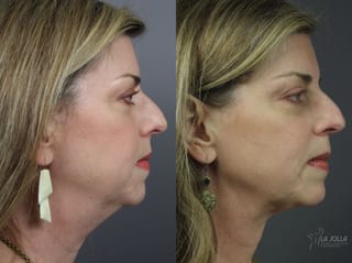 Before and after CoolSculpting® case 36084 - Angle 1