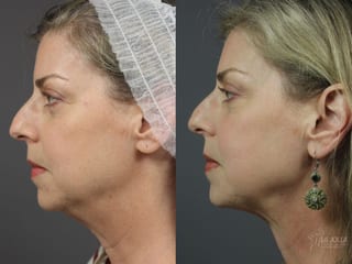 Before and after CoolSculpting® case 36084 - Angle 2