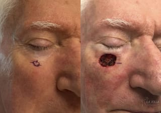Before and after Mohs Surgery case 36093 - Angle 1