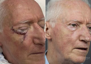 Before and after Mohs Surgery case 36093 - Angle 2