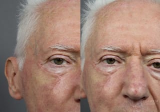 Before and after Mohs Surgery case 36093 - Angle 3