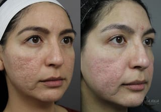 Before and after Acne Scars: Subcision case 36097 - Angle 2