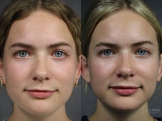 Before and after Lip Filler case 36098 - Angle 1