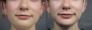 Before and after Lip Filler case 36098 - Angle 2