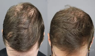 Before and after PRP (Platelet-Rich Plasma) case 36099 - Angle 1
