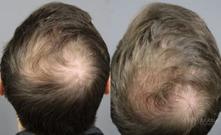 Before and after PRP (Platelet-Rich Plasma) case 36099 - Angle 2