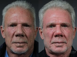 Before and after Ablative Laser Treatment case 36100 - Angle 1