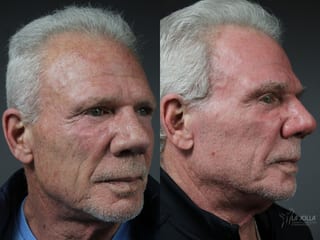 Before and after Ablative Laser Treatment case 36100 - Angle 2