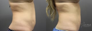 Before and after CoolSculpting® case 36101 - Angle 3