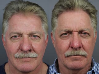 Before and after Laser for Rhinophyma case 36103 - Angle 2