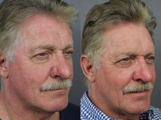 Before and after Laser for Rhinophyma case 36103 - Angle 3