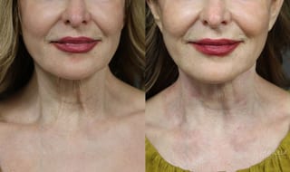 Before and after Laser Coring (Poke A Dot Lift®) case 36104 - Angle 1